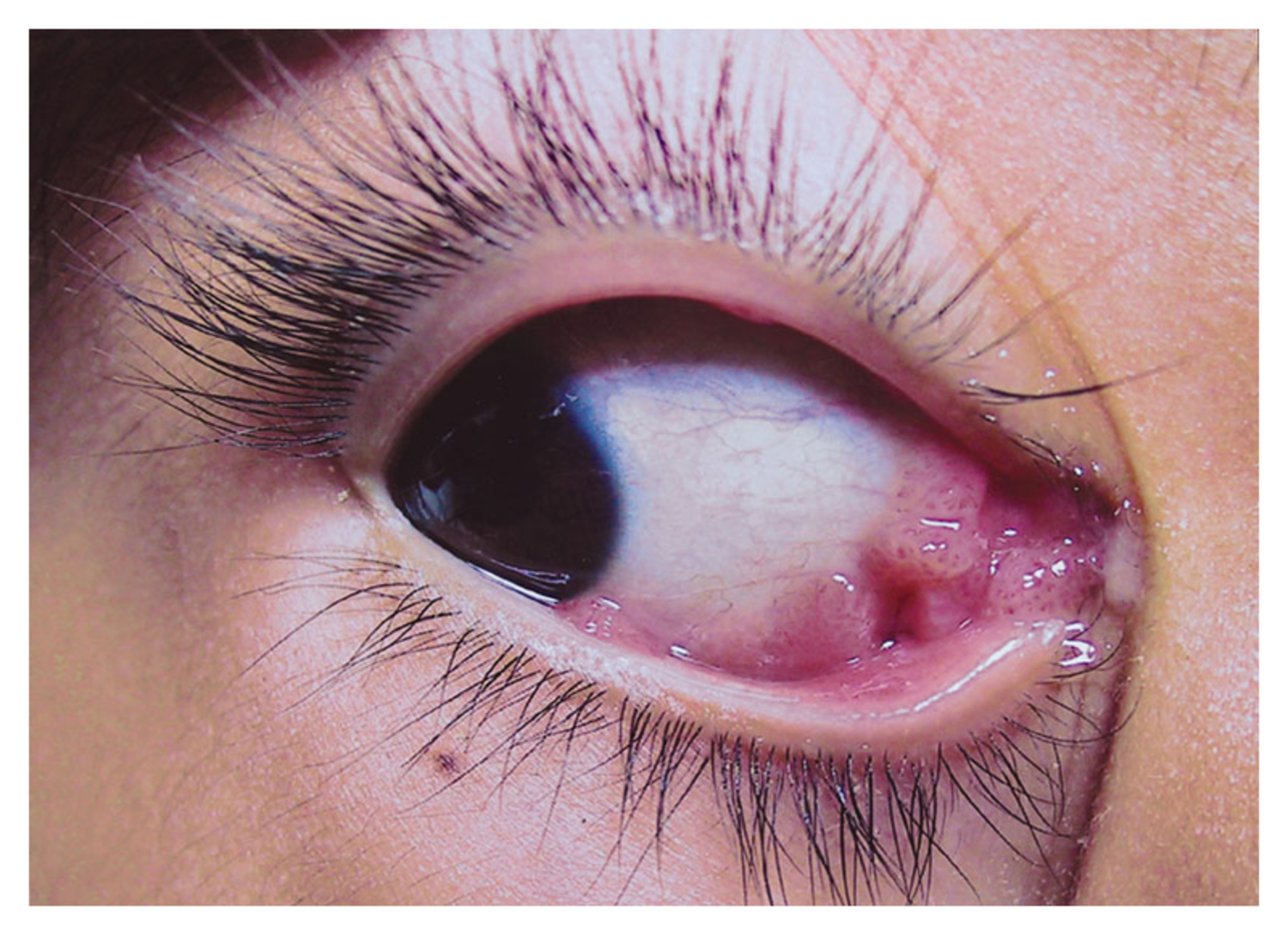 Papilloma