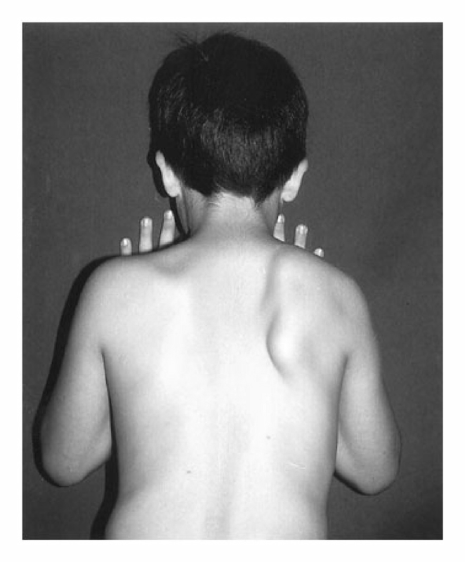 Palsy of the long thoracic nerve