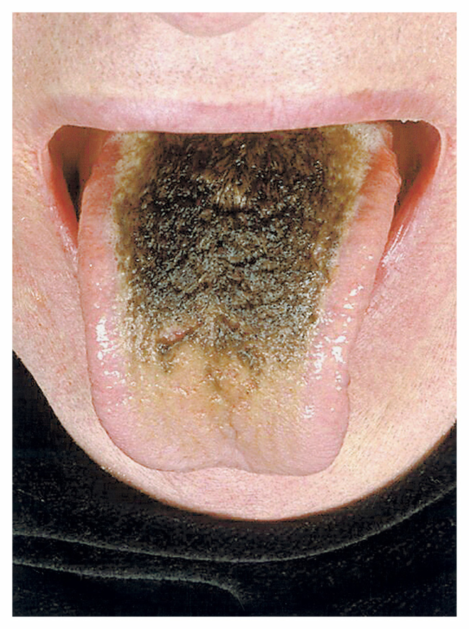 Lingua villosa nigra