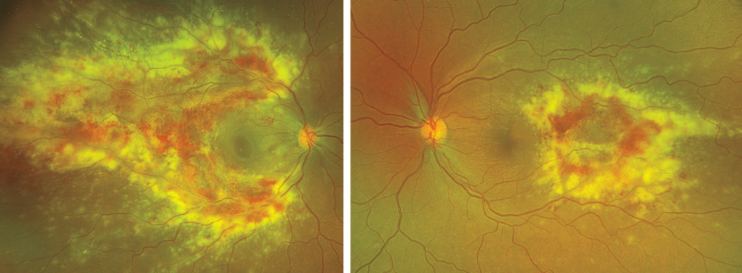 Cytomegalovirus retinitis