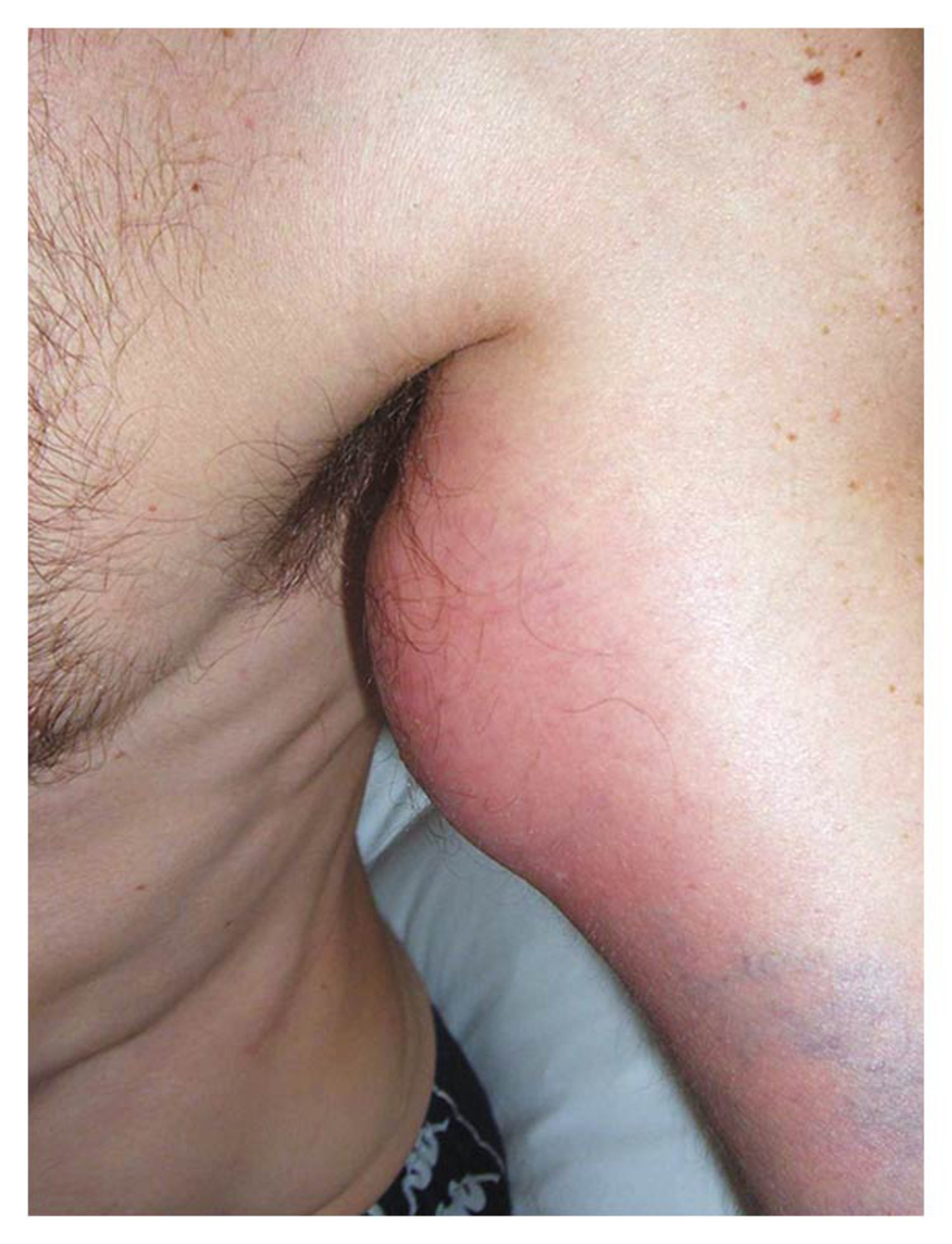 Abscess