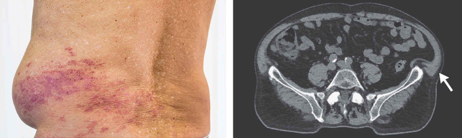 Postherpetic abdominal pseudohernia