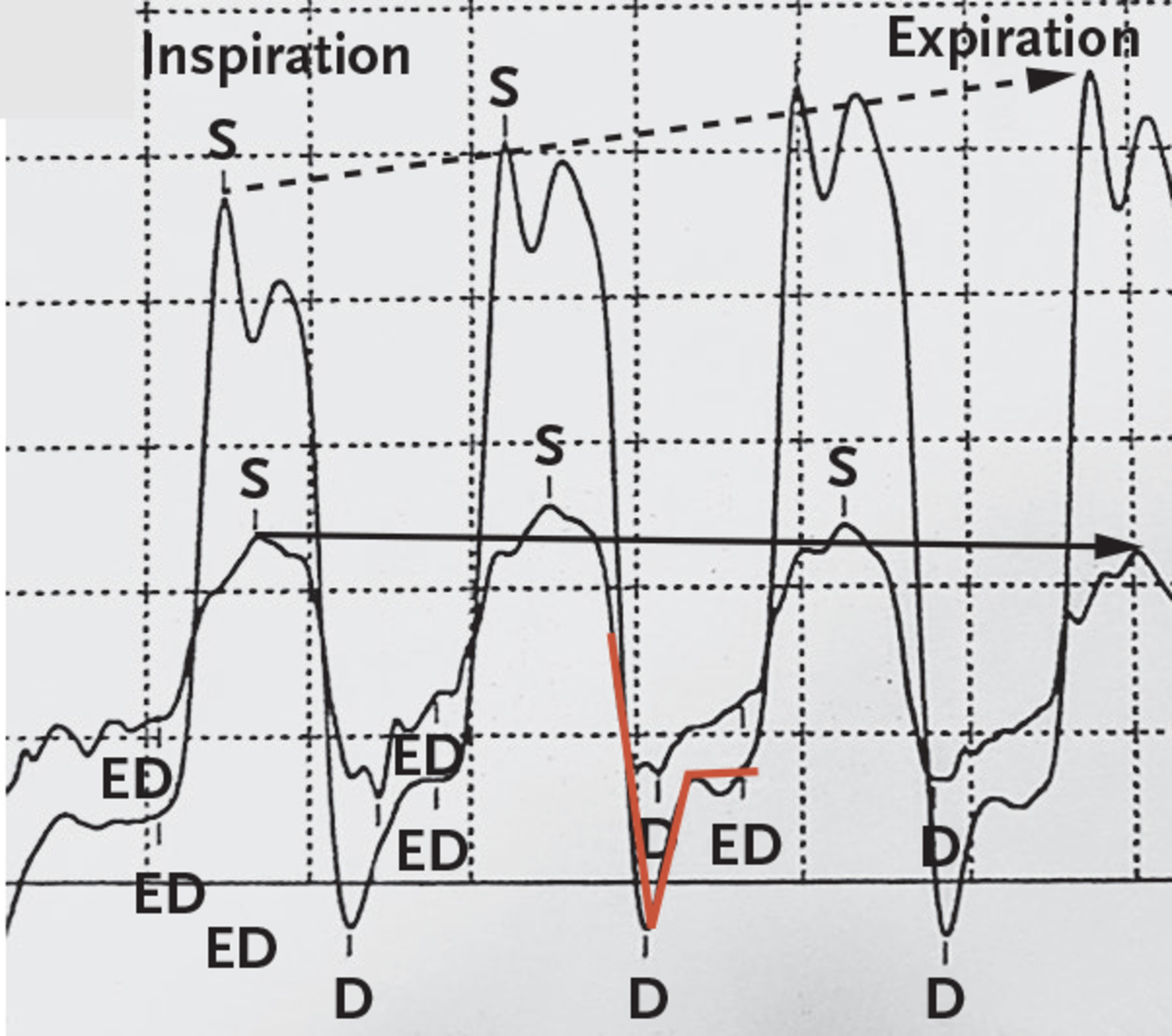 Constrictive Pericarditis