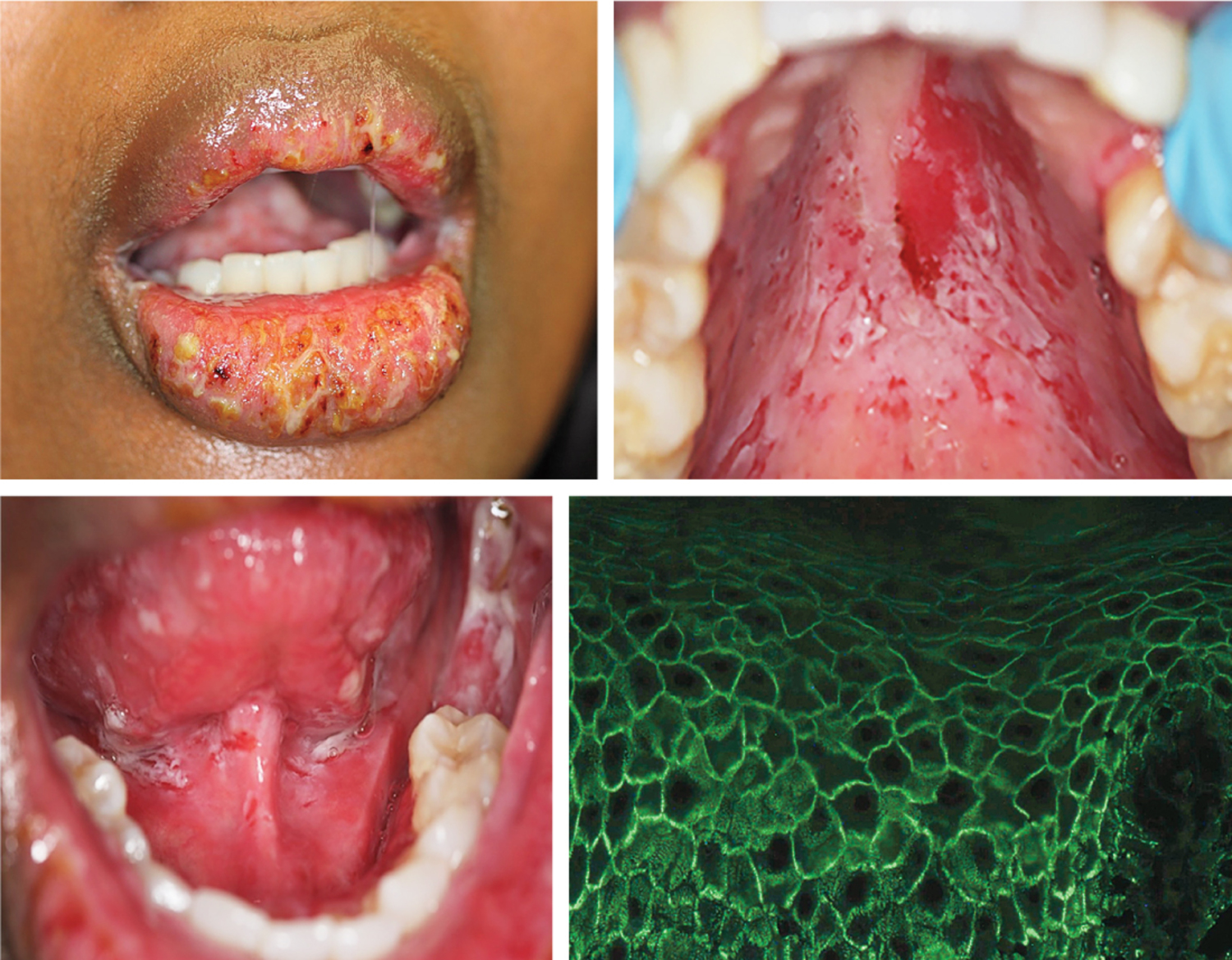 Pemphigus vulgaris