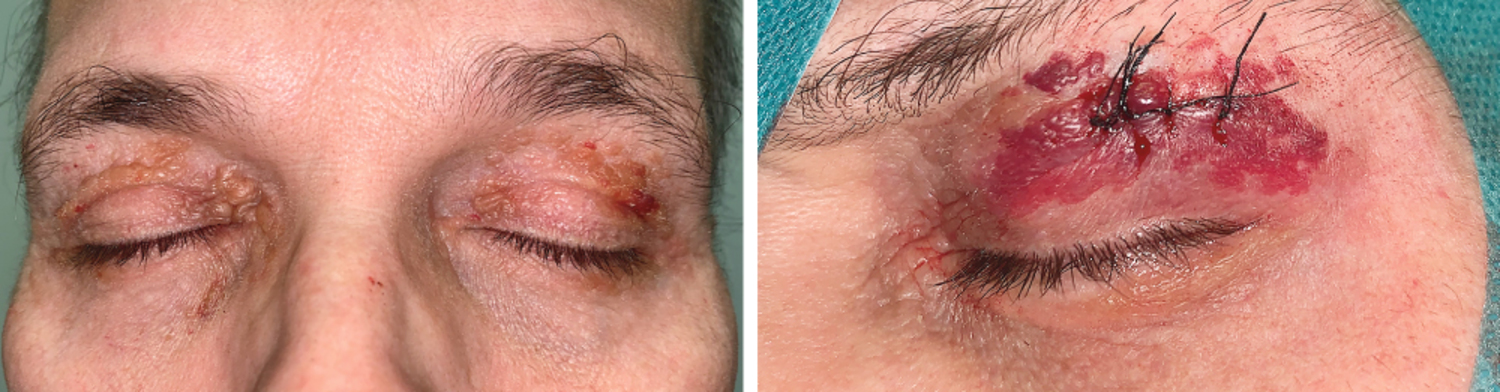 Vascular fragility owing to infiltration of vessel walls