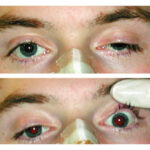 Skull fracture