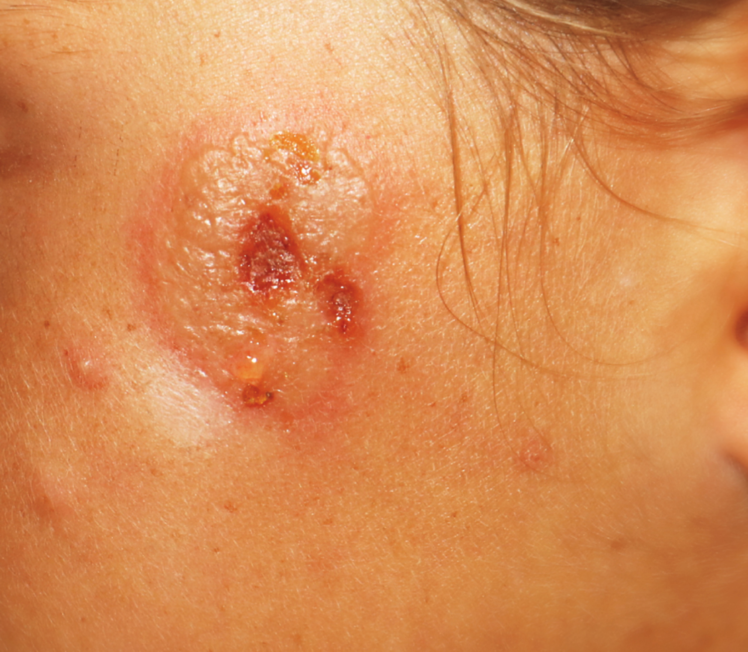 Primary cutaneous HSV-1 infection