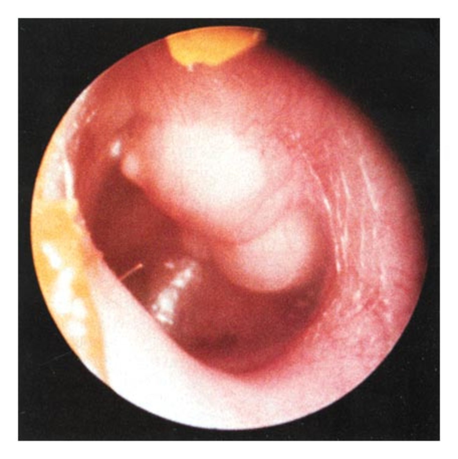 Cholesteatoma