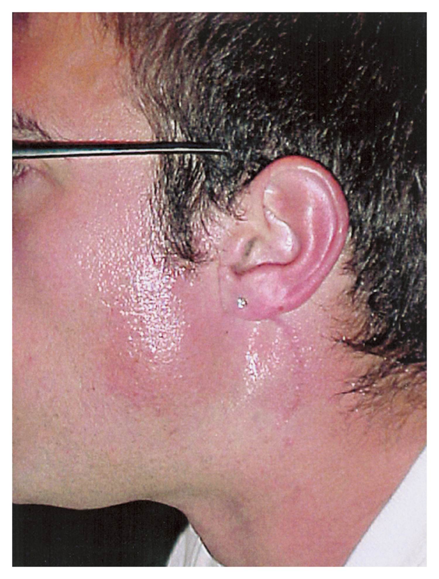 Frey's syndrome
