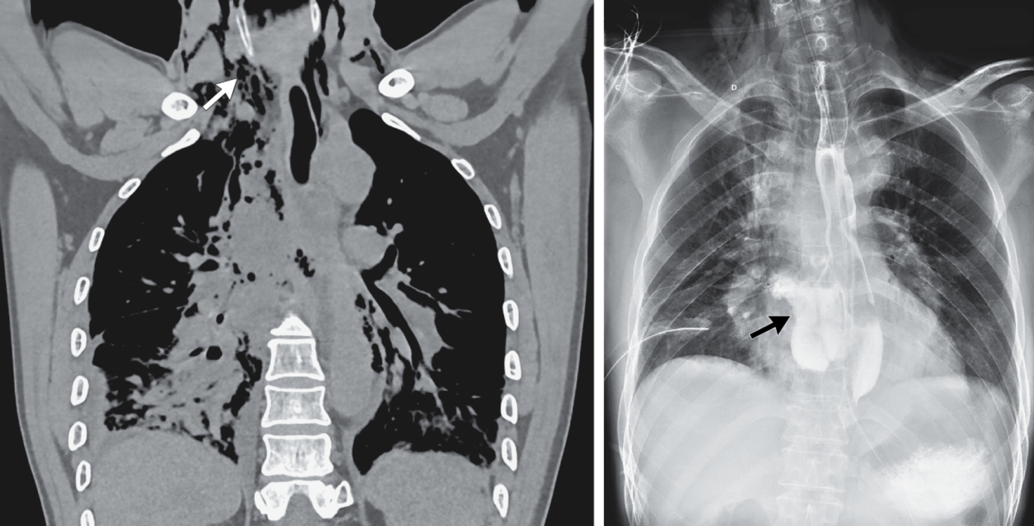 Esophageal rupture