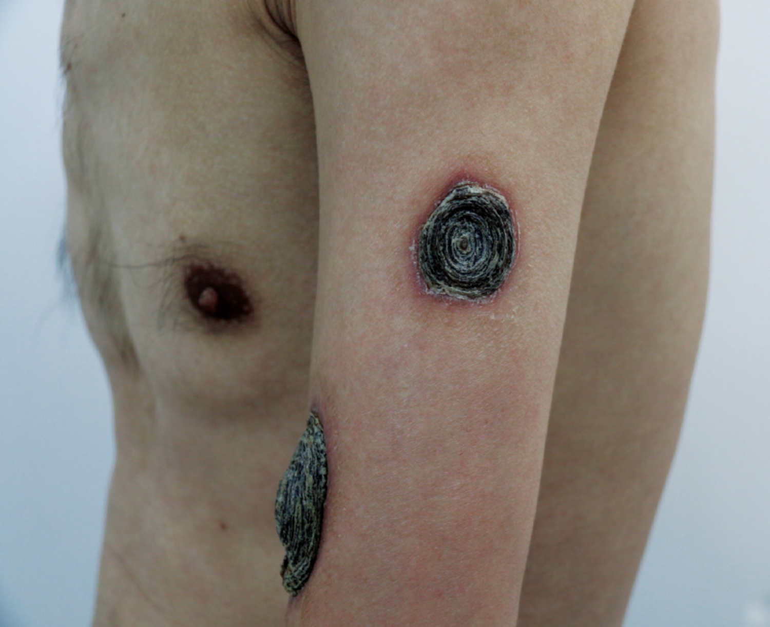 Malignant syphilis