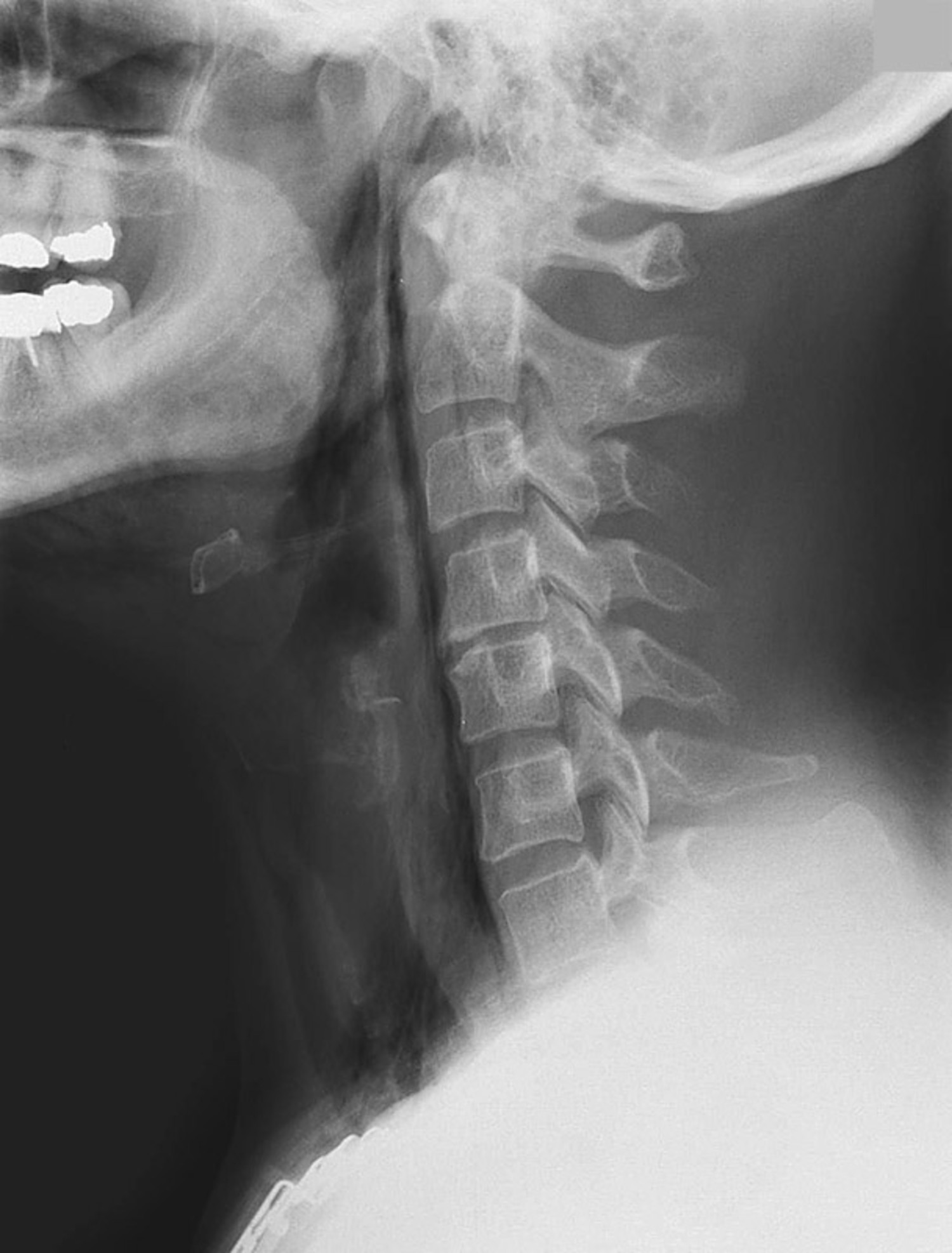 Prevertebral air