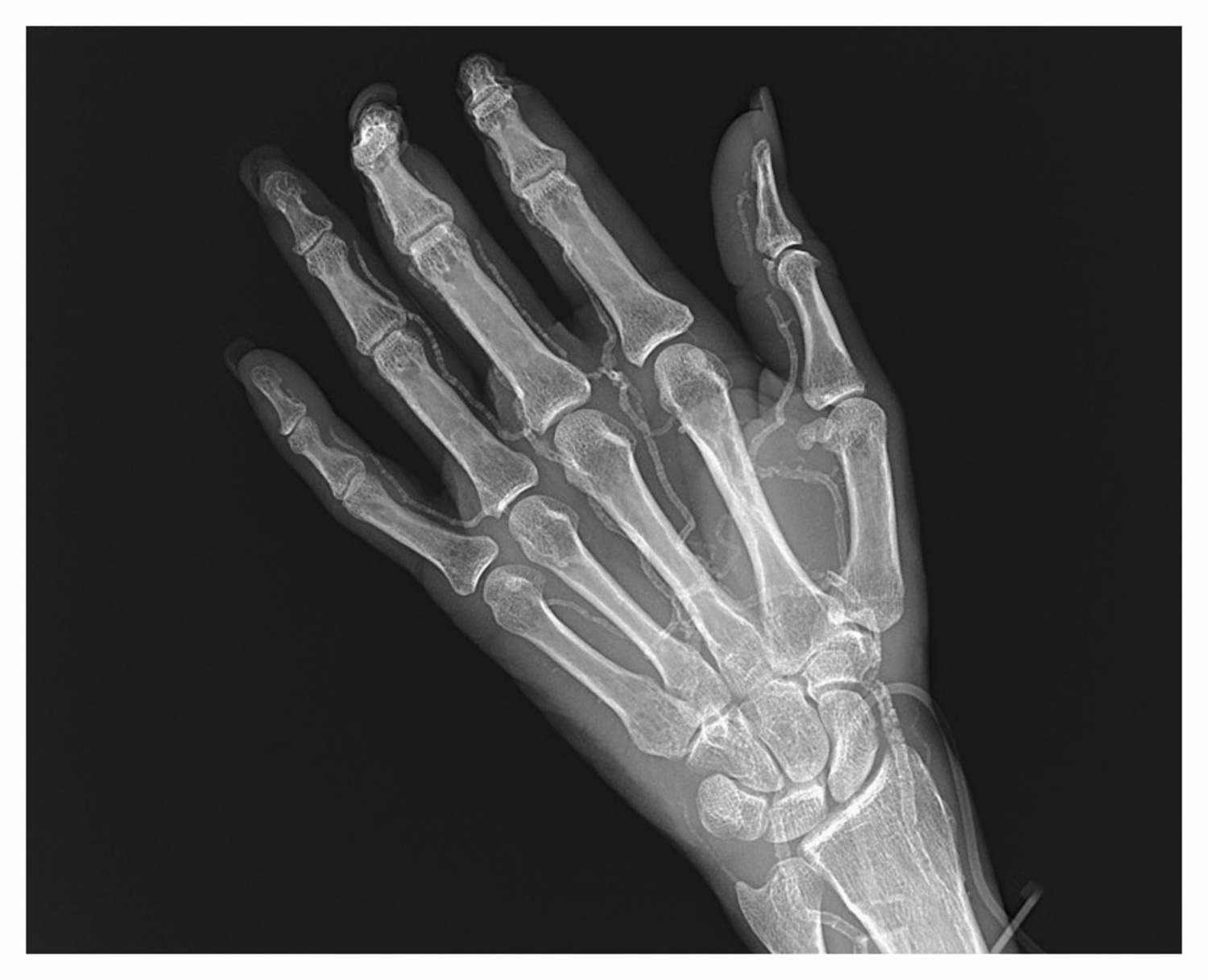Calciphylaxis