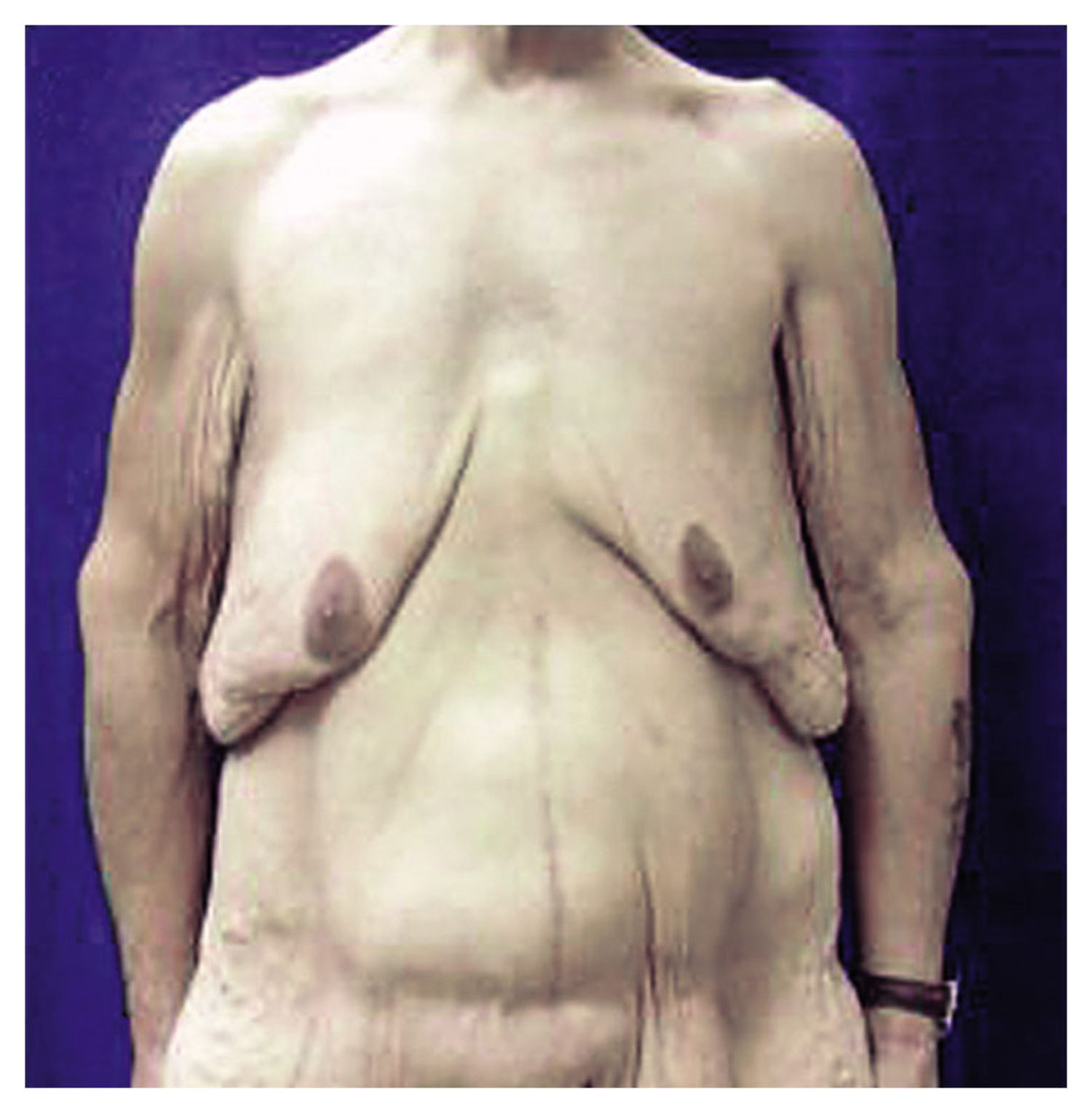 Gastric bypass