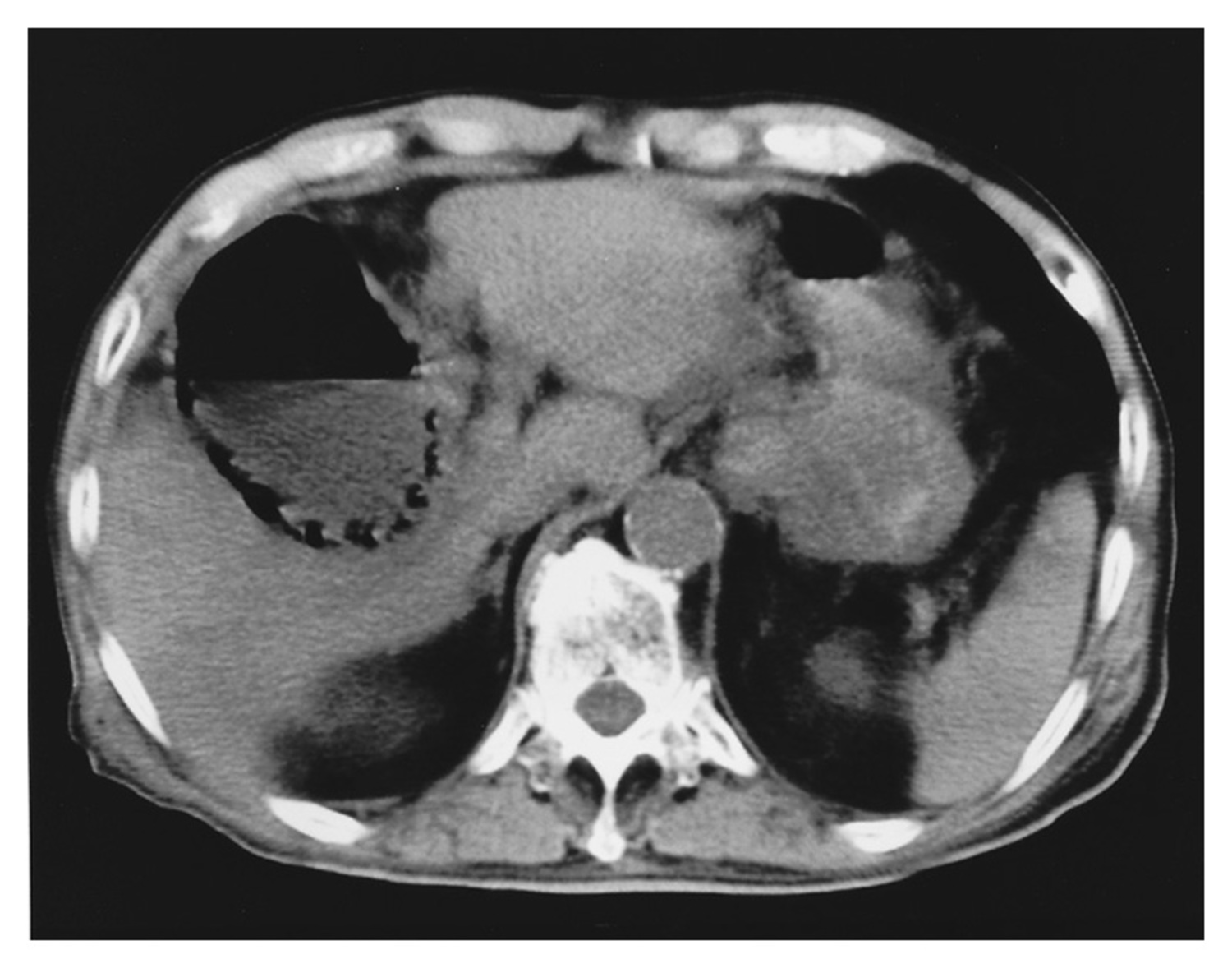 Emphysematous cholecystitis