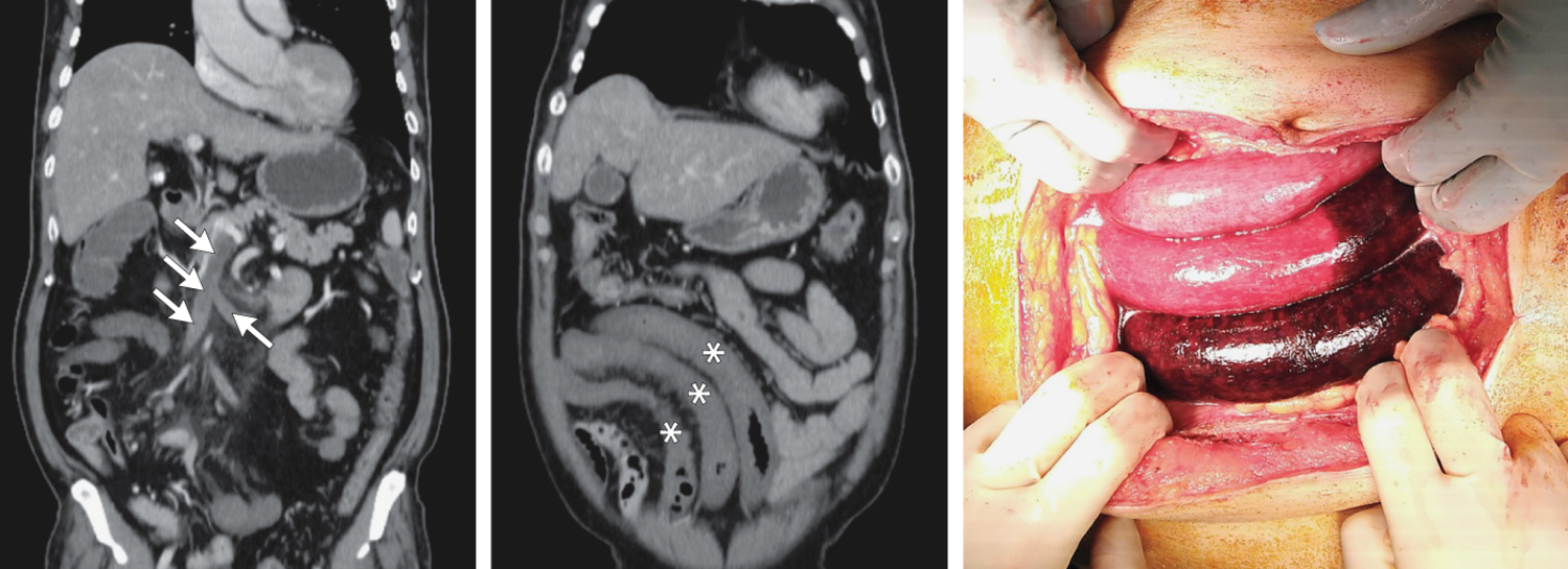 Small-Bowel Infarction