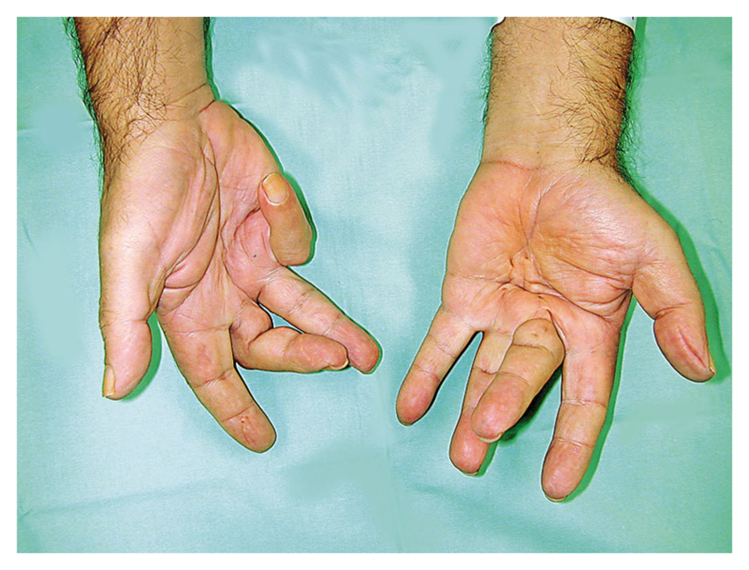 Dupuyten's contracture