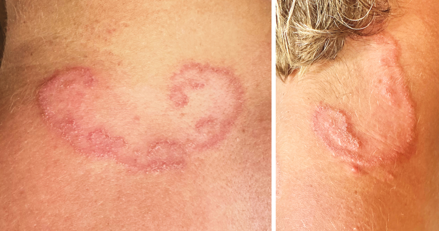 Cutaneous larva migrans