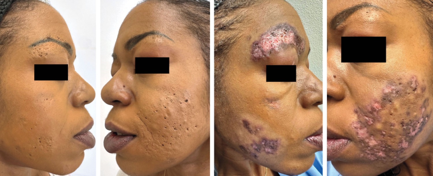 Discoid lupus erythematosus