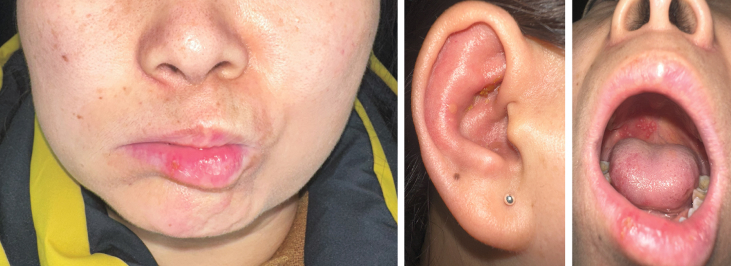 Herpes zoster oticus