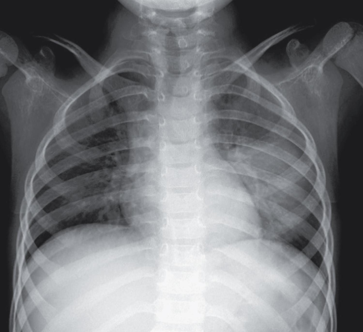 Round Pneumonia