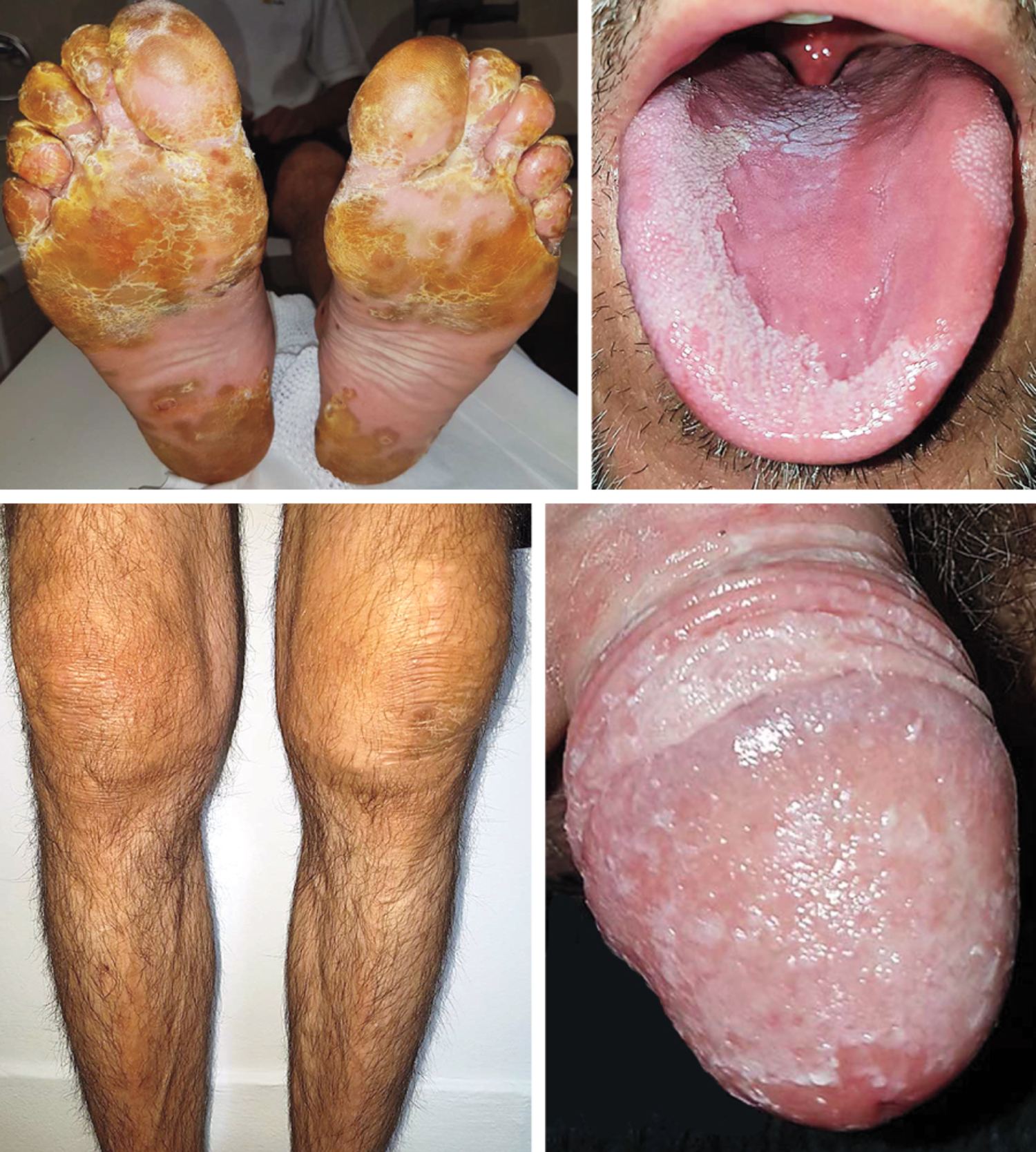 Keratoderma blenorrhagicum