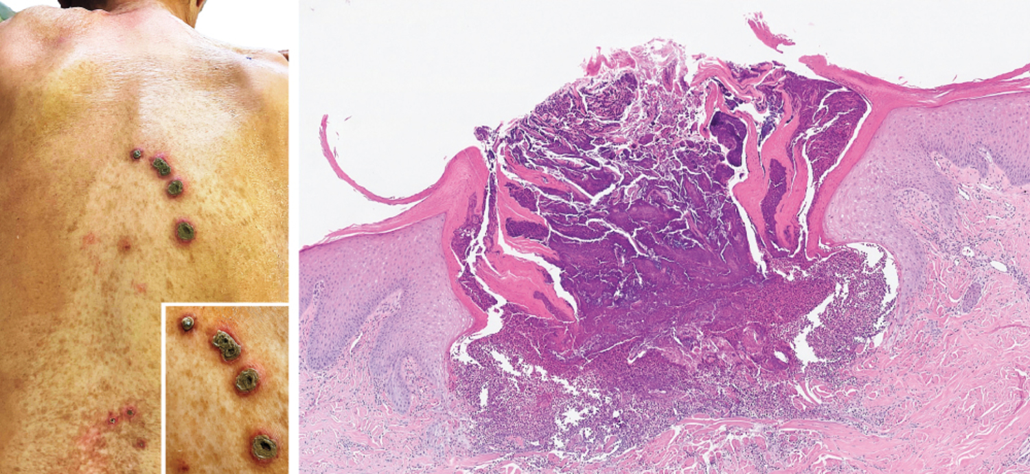 Reactive perforating collagenosis