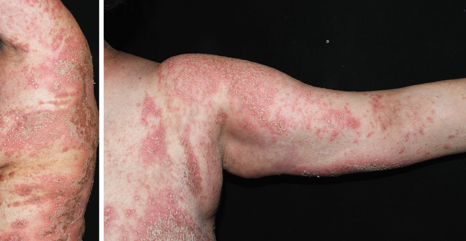 Iododerma