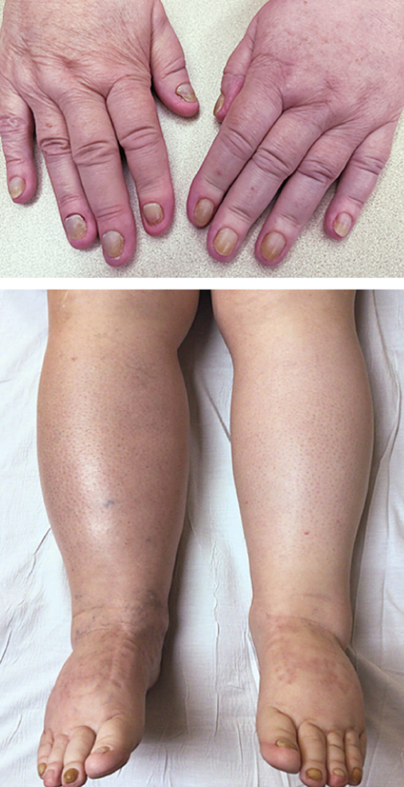 Yellow nail syndrome