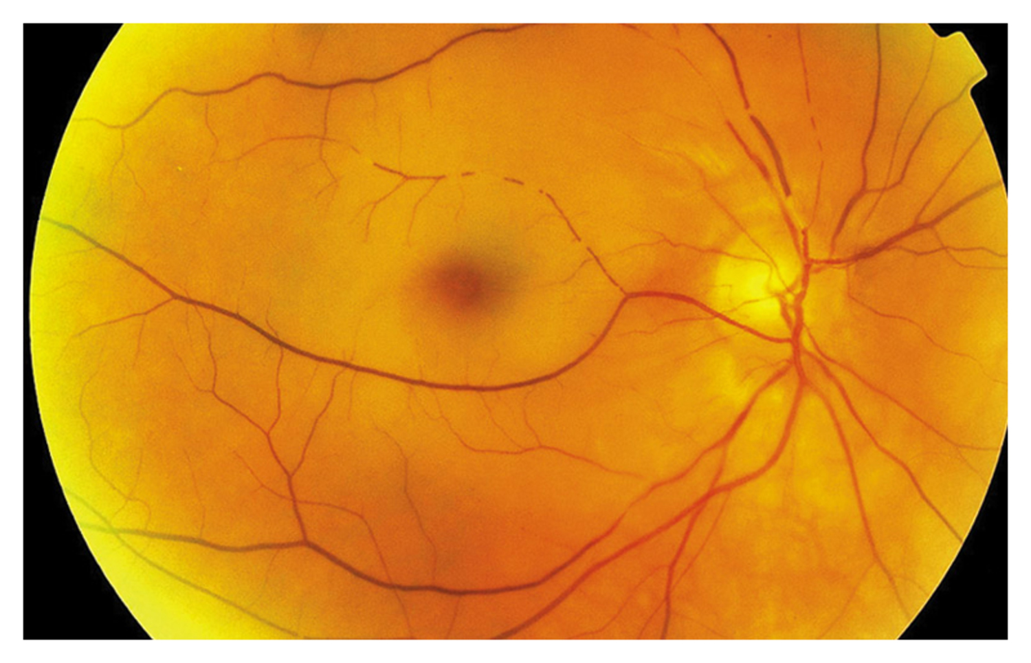 Central retinal artery occlusion