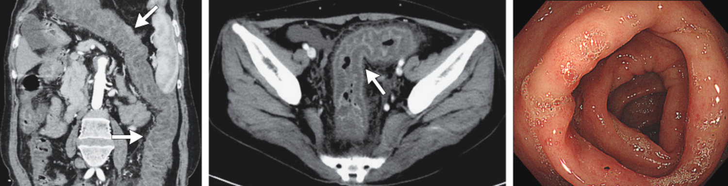 Acquired C1 inhibitor deficiency