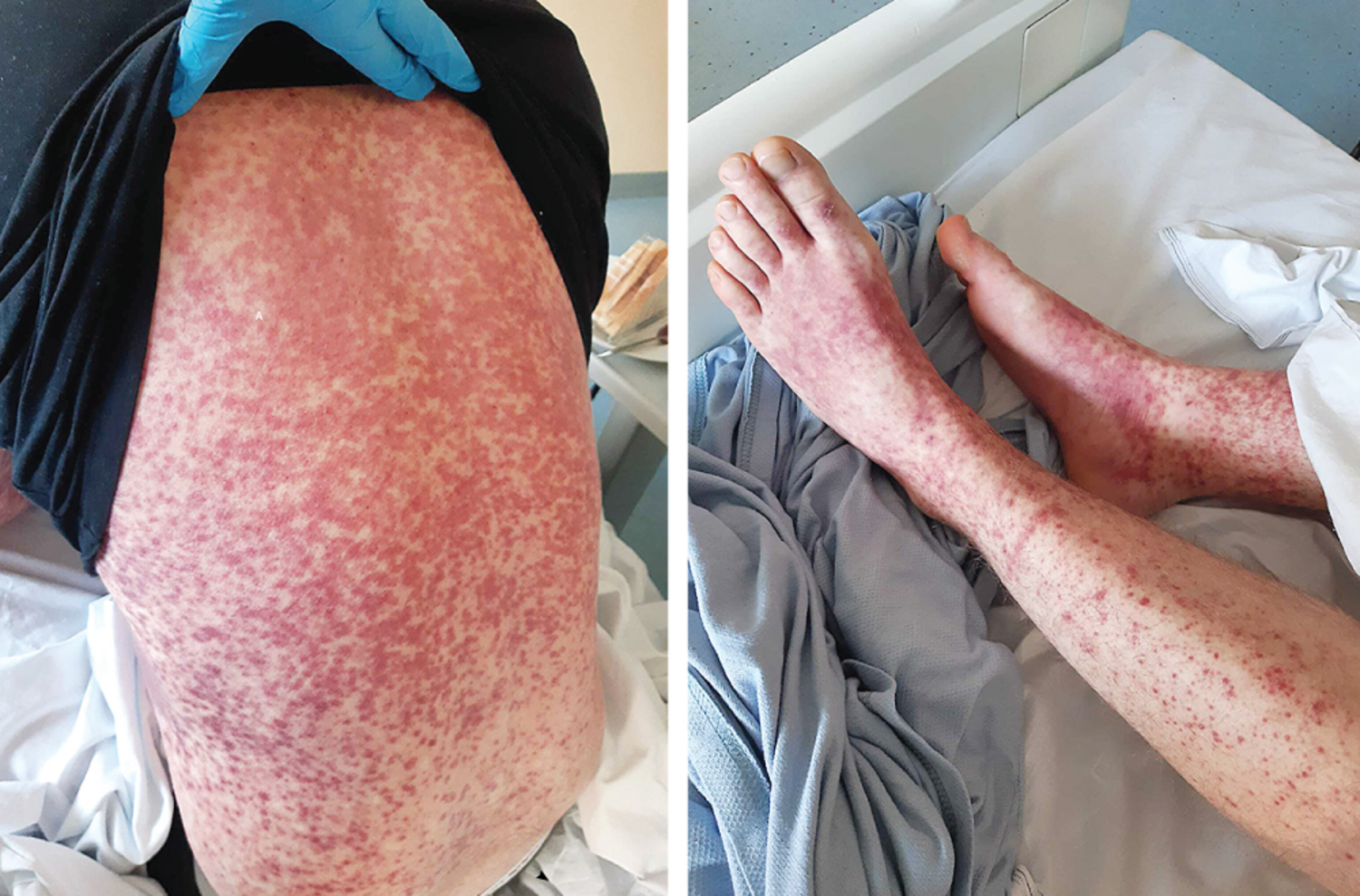 Type III hypersensitivity reaction