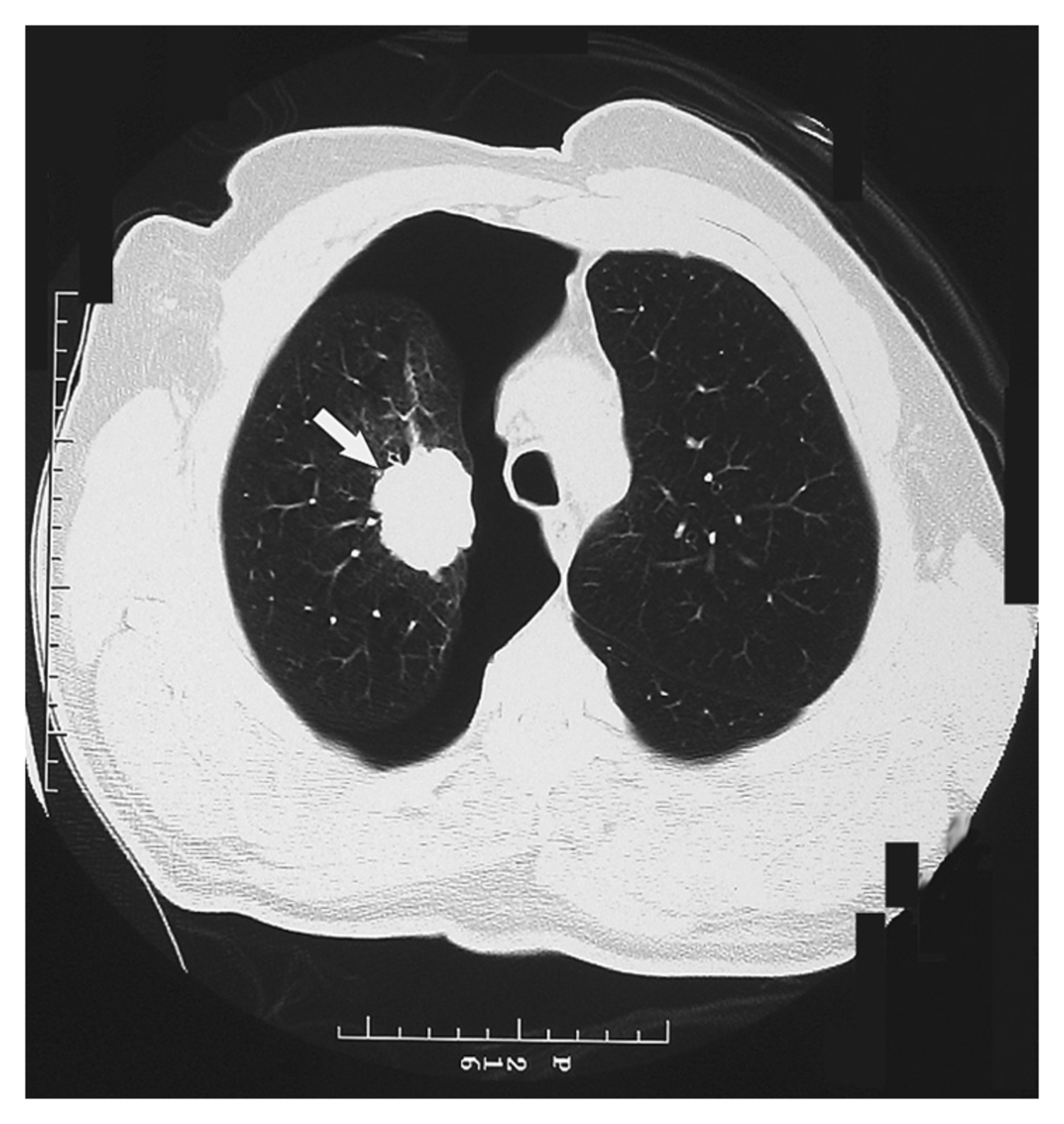 Adenocarcinoma