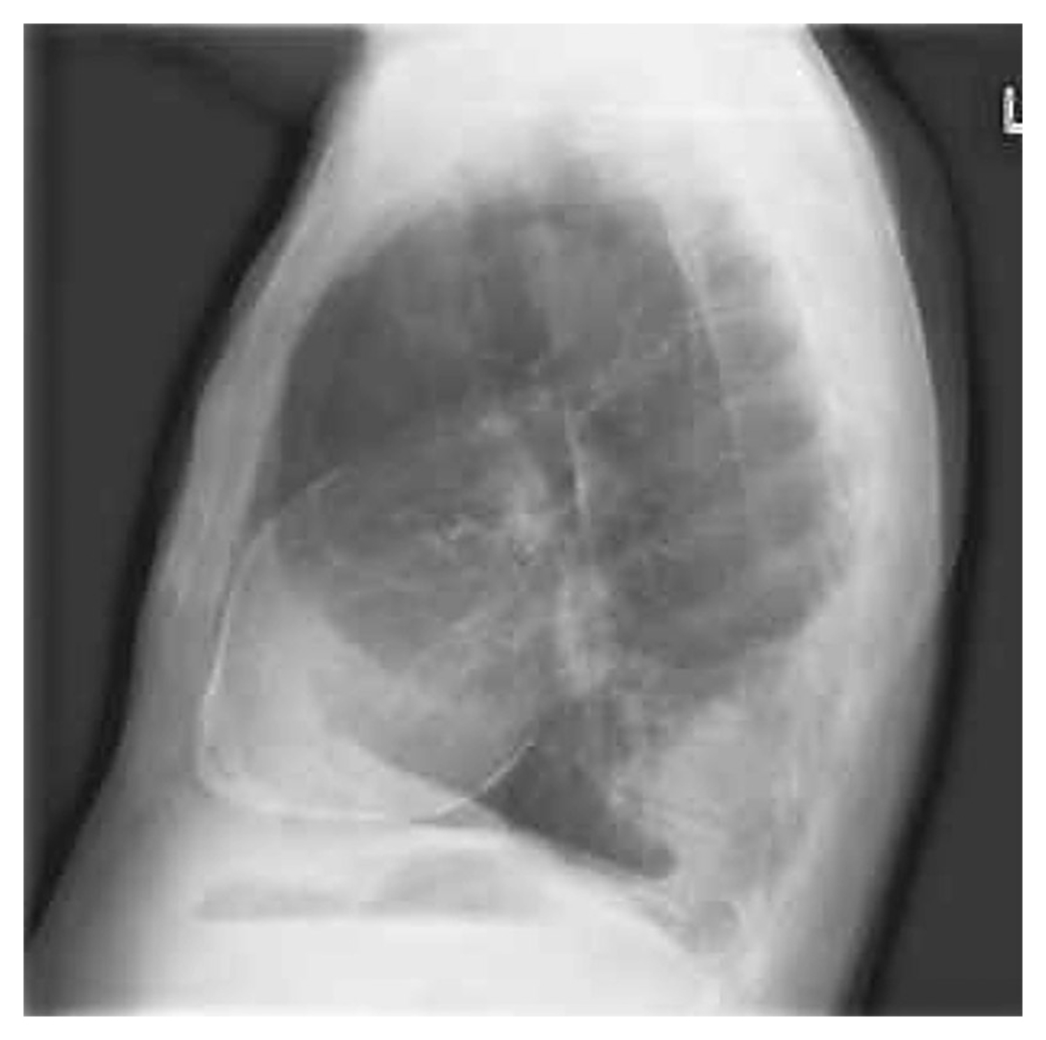 Constrictive pericarditis