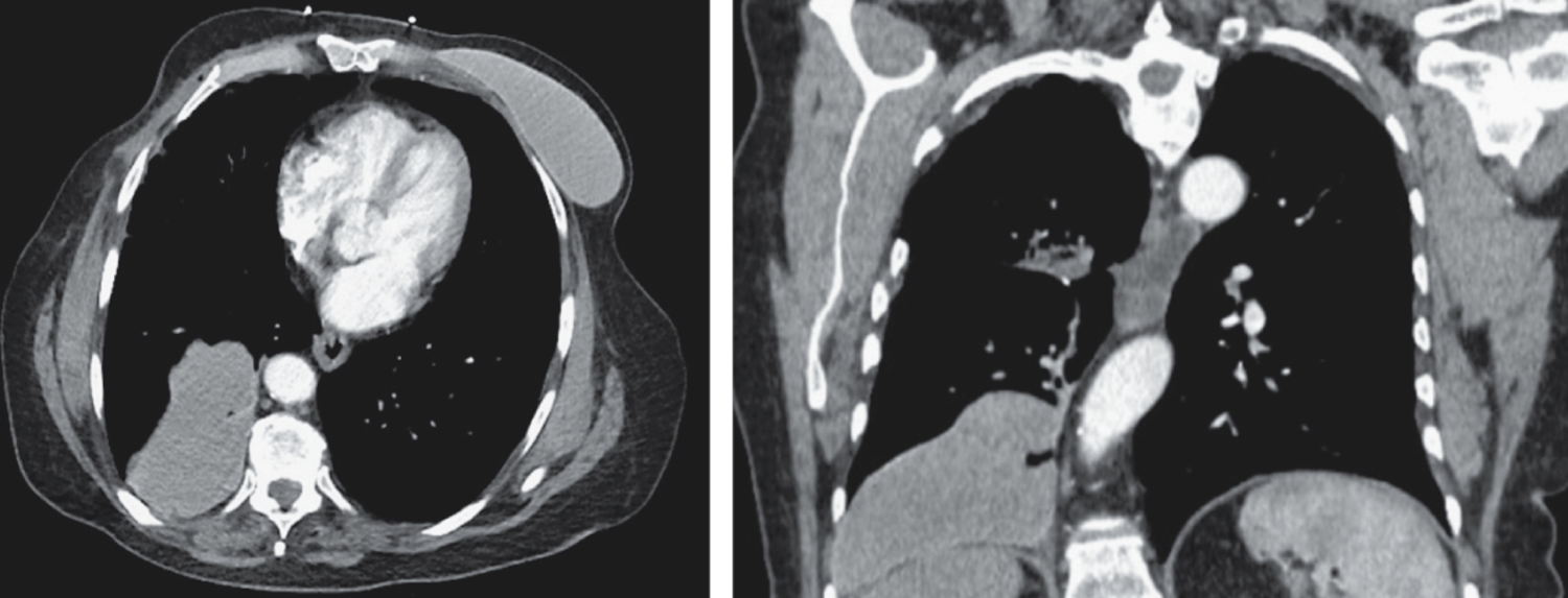 Intrathoracic migration of a breast implant