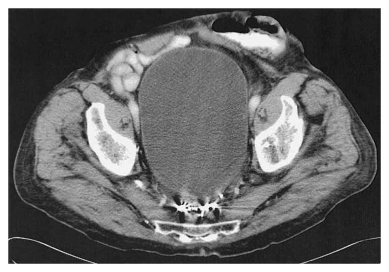 Urinary retention