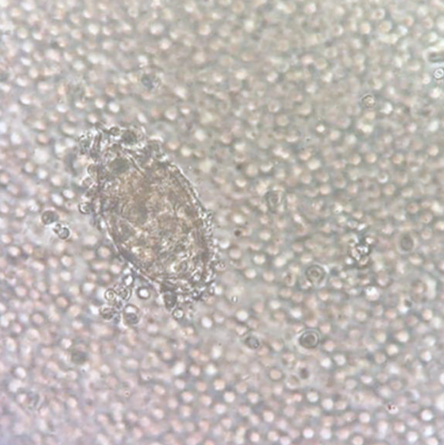 Schistosoma hematobium