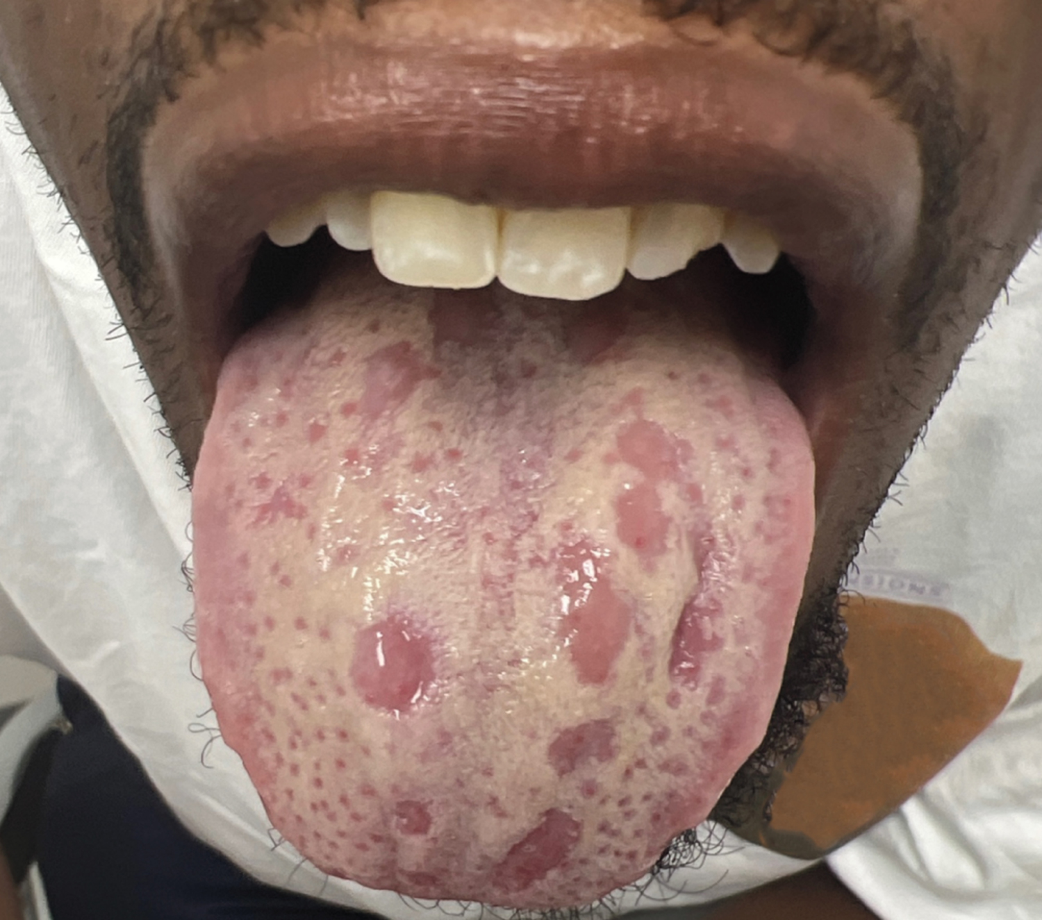 Secondary syphilis