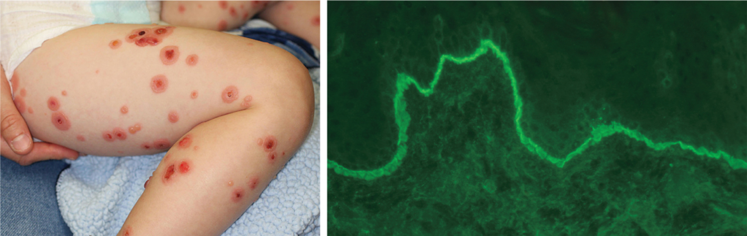 Linear IgA bullous dermatosis of childhood