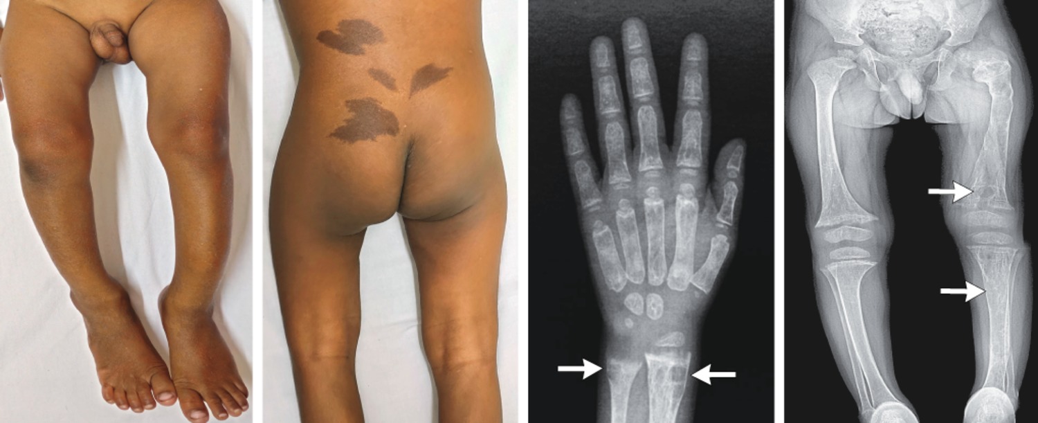 McCune–Albright syndrome