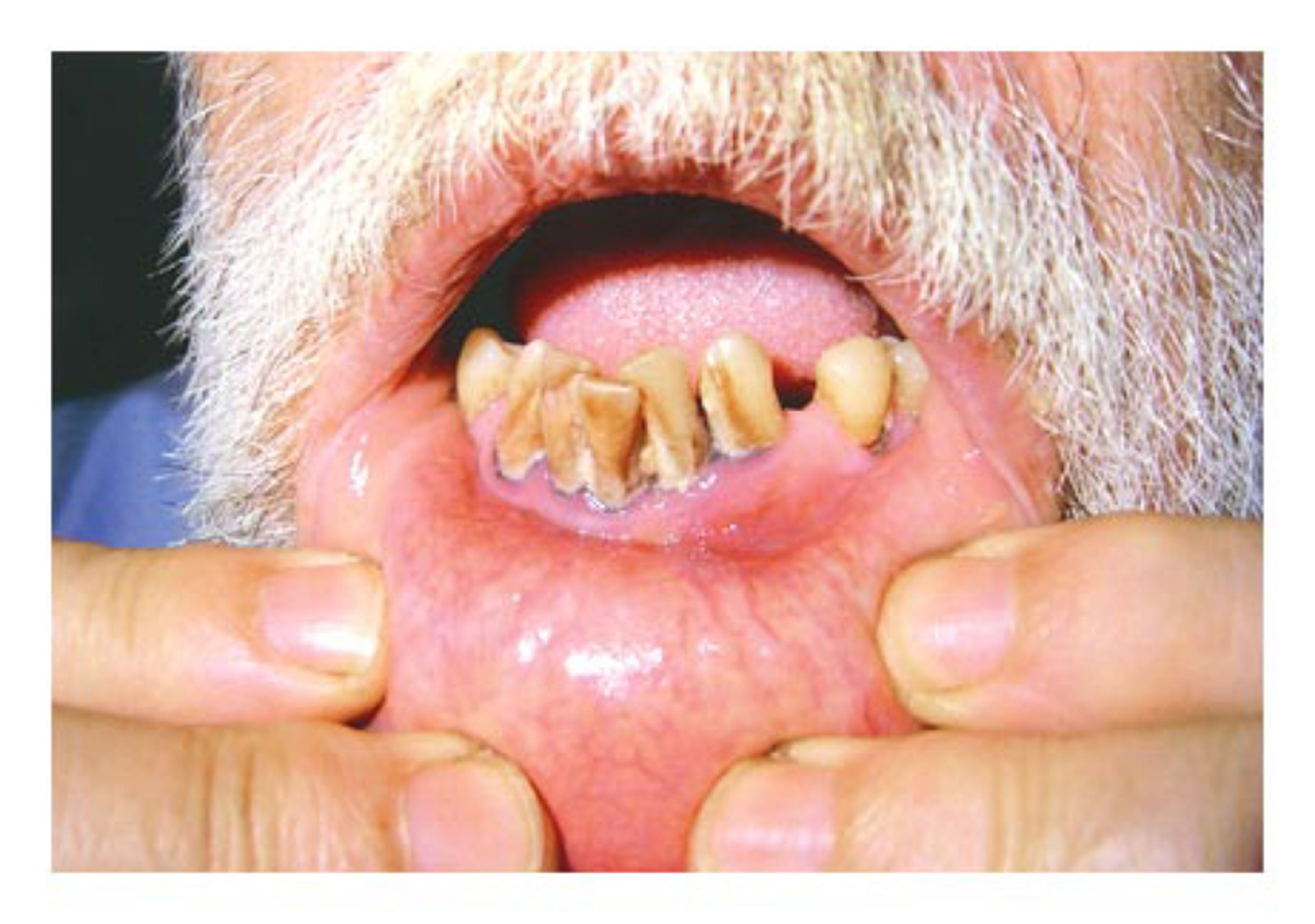 Chronic lead poisoning
