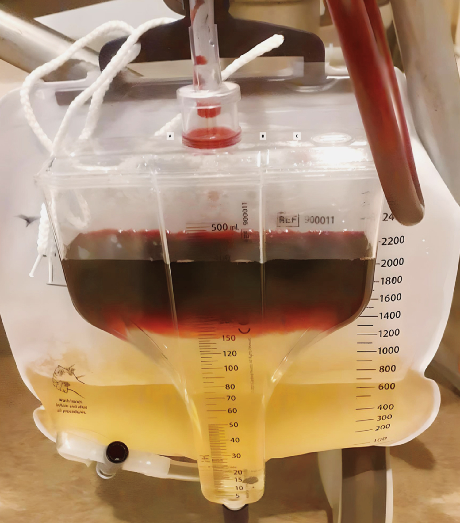 Hydroxocobalamin-induced discoloration