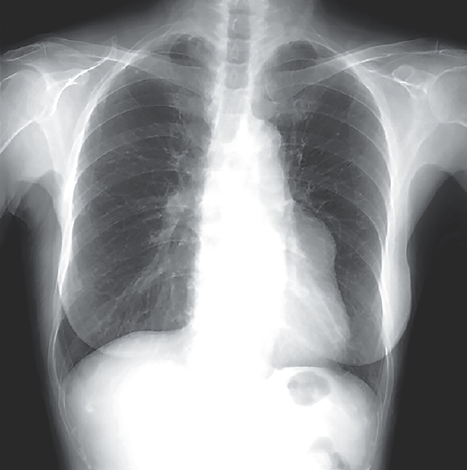 Giant Coronary Aneurysm