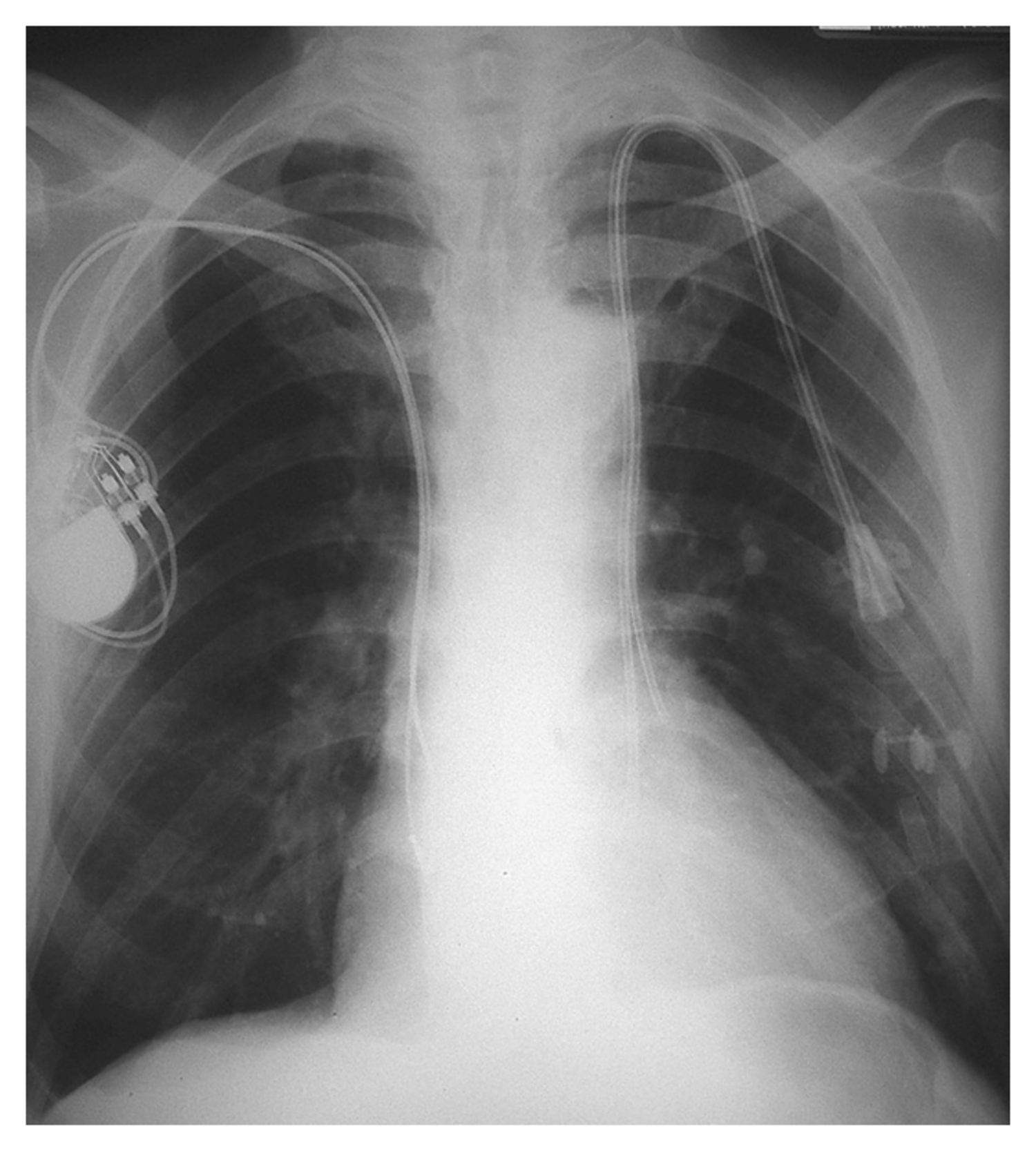 Left-sided superior vena cava