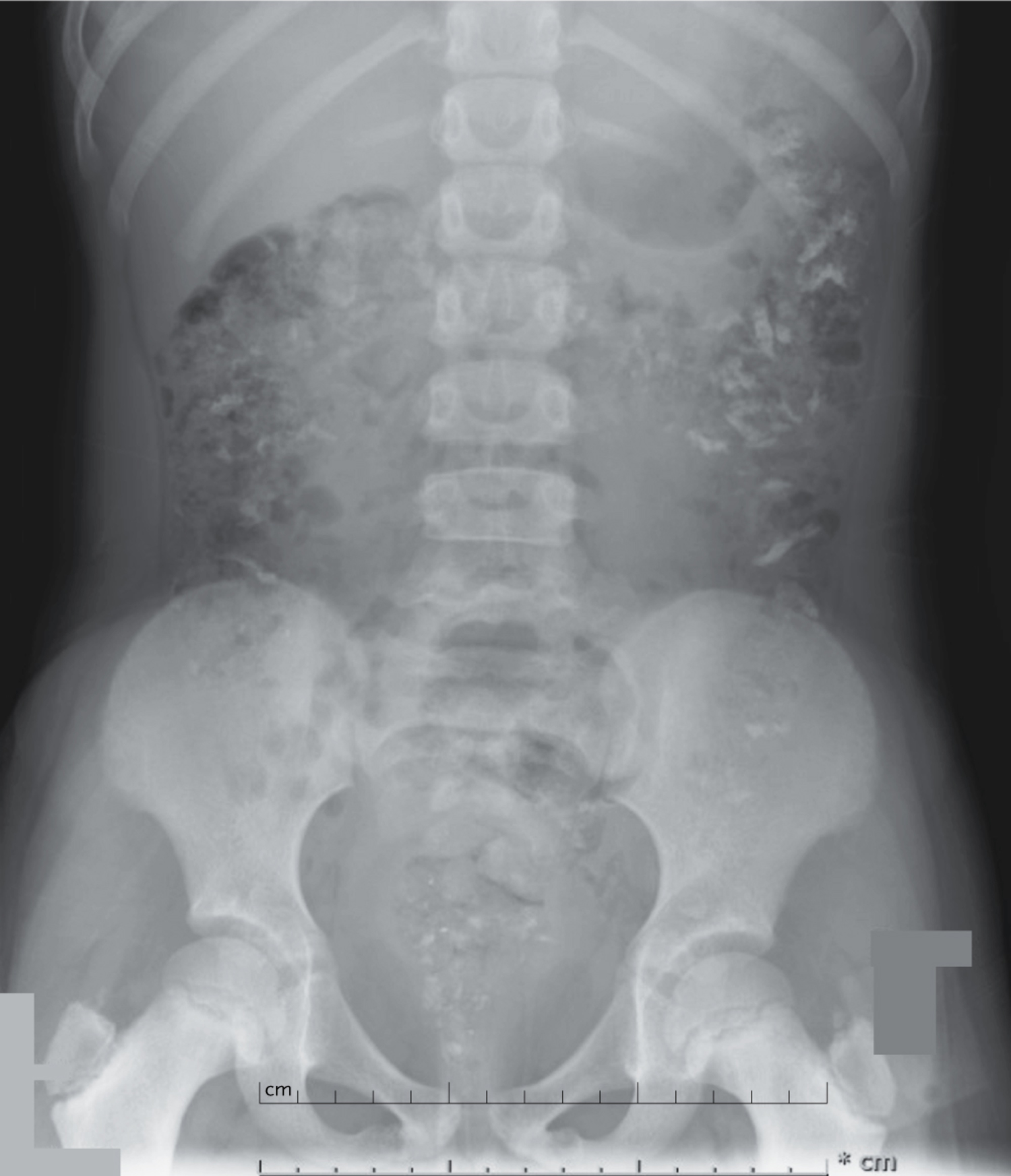 Lead poisoning