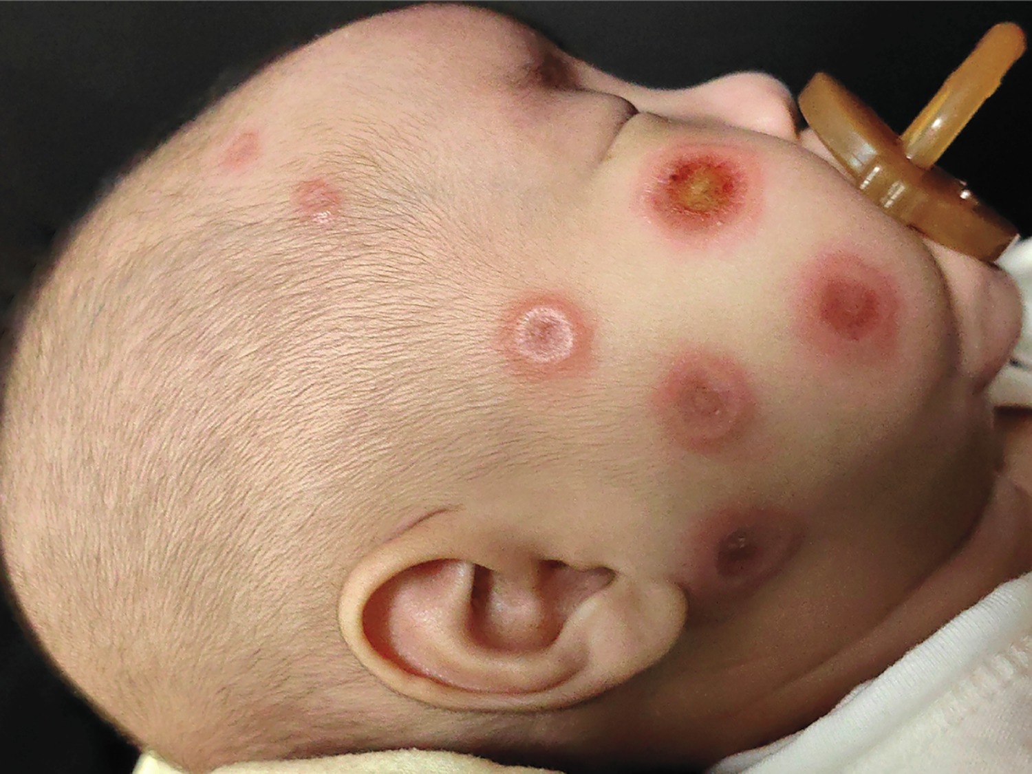 Neonatal lupus erythematosus