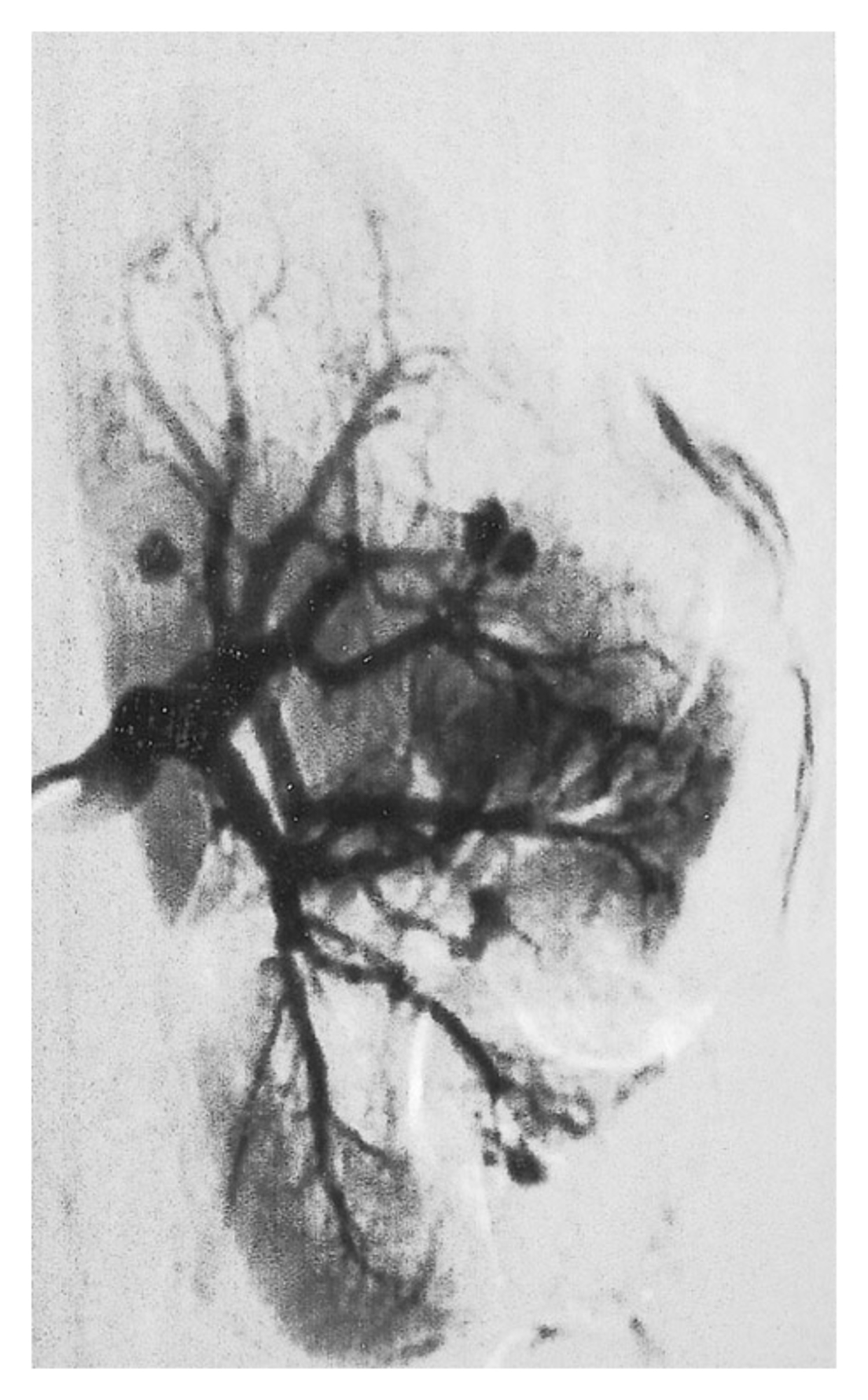 Polyarteritis nodosa