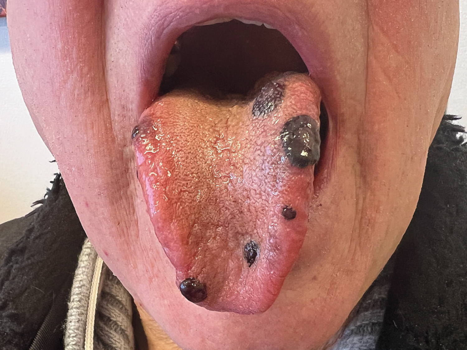 Thrombocytopenia