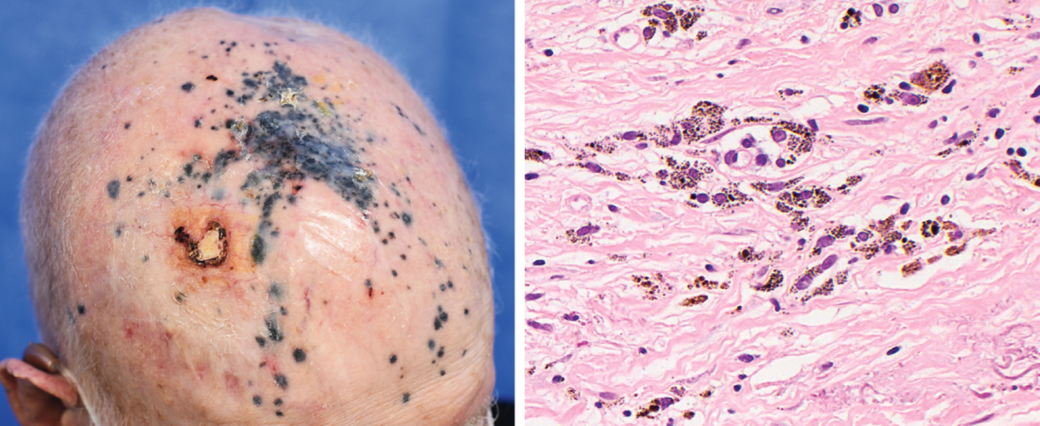 Tumoral melanosis