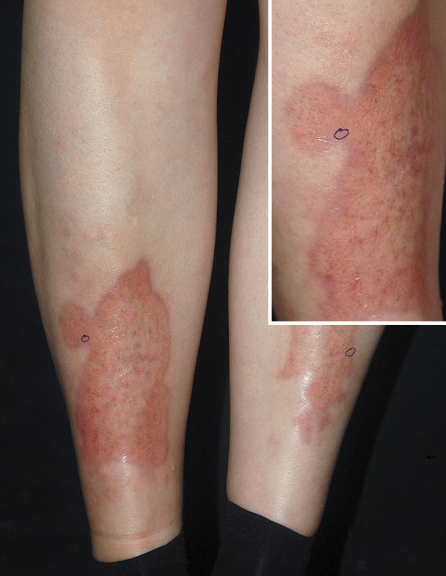 Necrobiosis lipoidica
